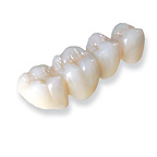 Fixed Porcelain Bridge